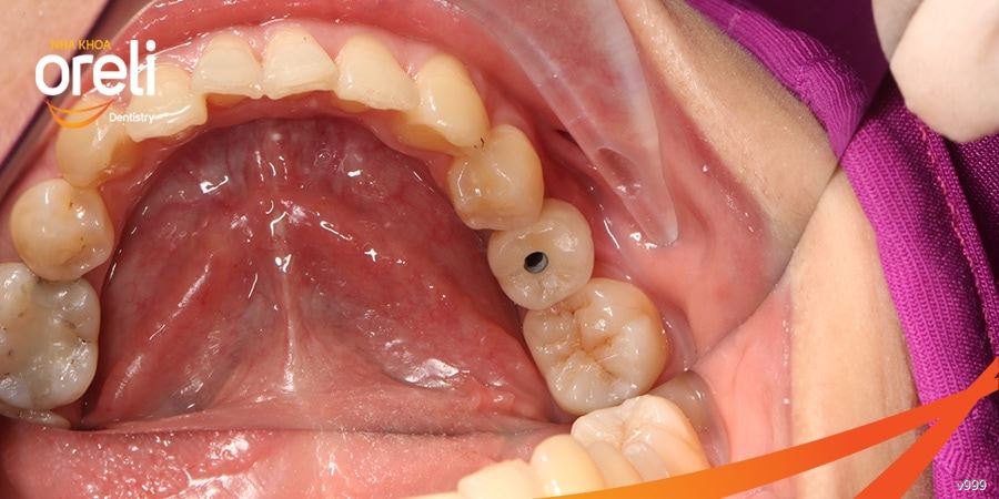 cấy implant uy tín bmt