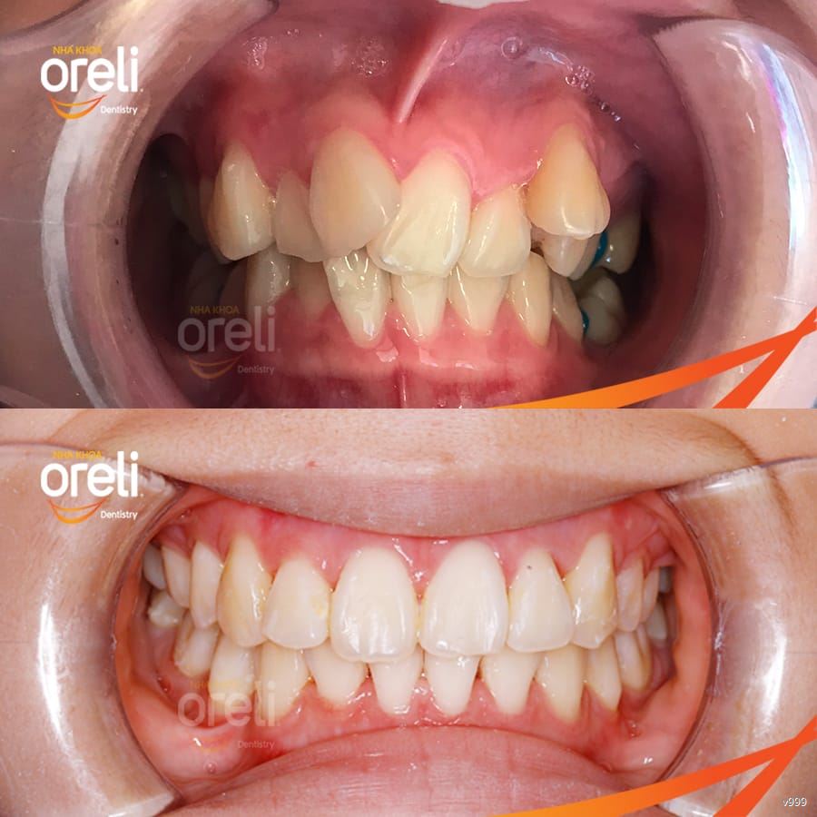 nieng rang uy tin nha khoa oreli bmt